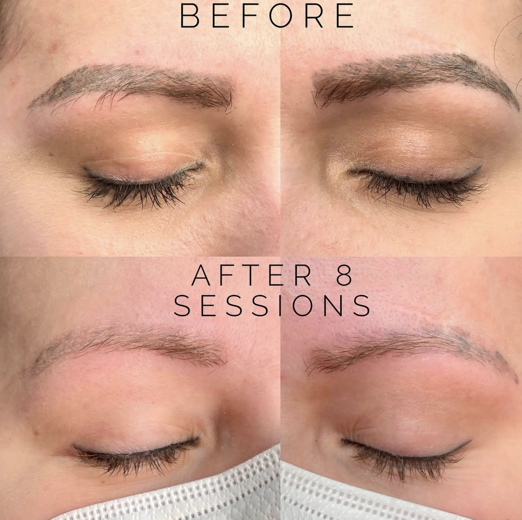 brow tattoo removal