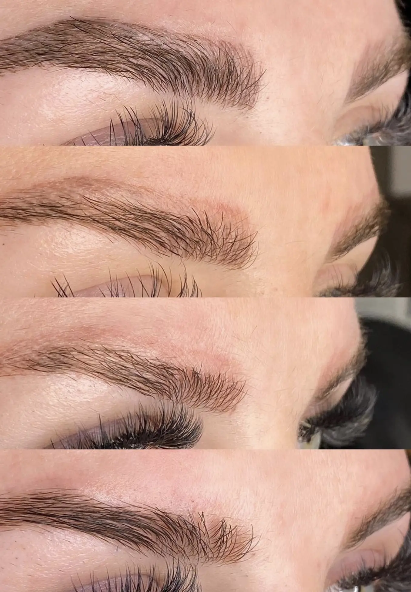 eyebrow laser tattoo removal