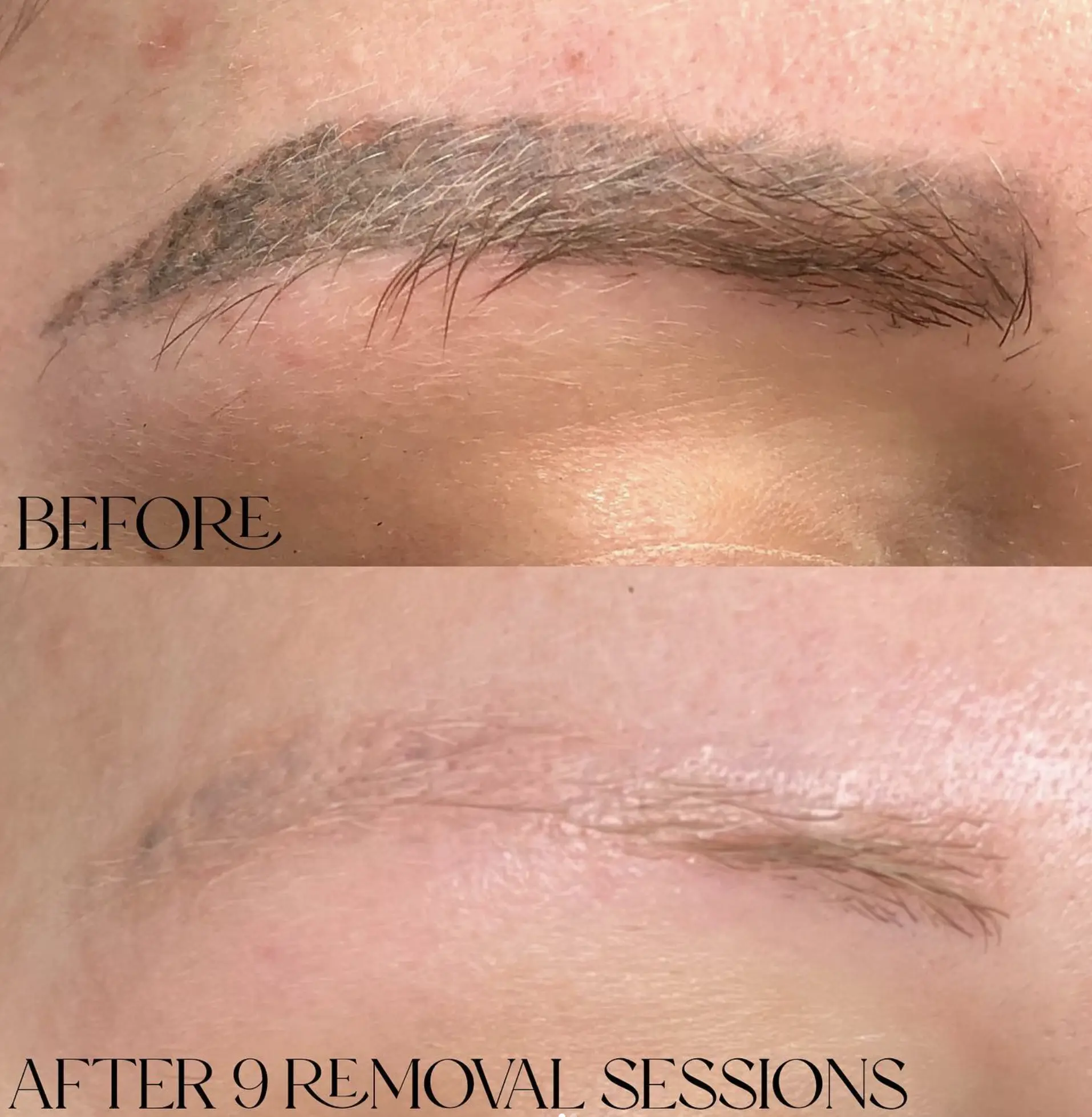 saline brow tattoo removal