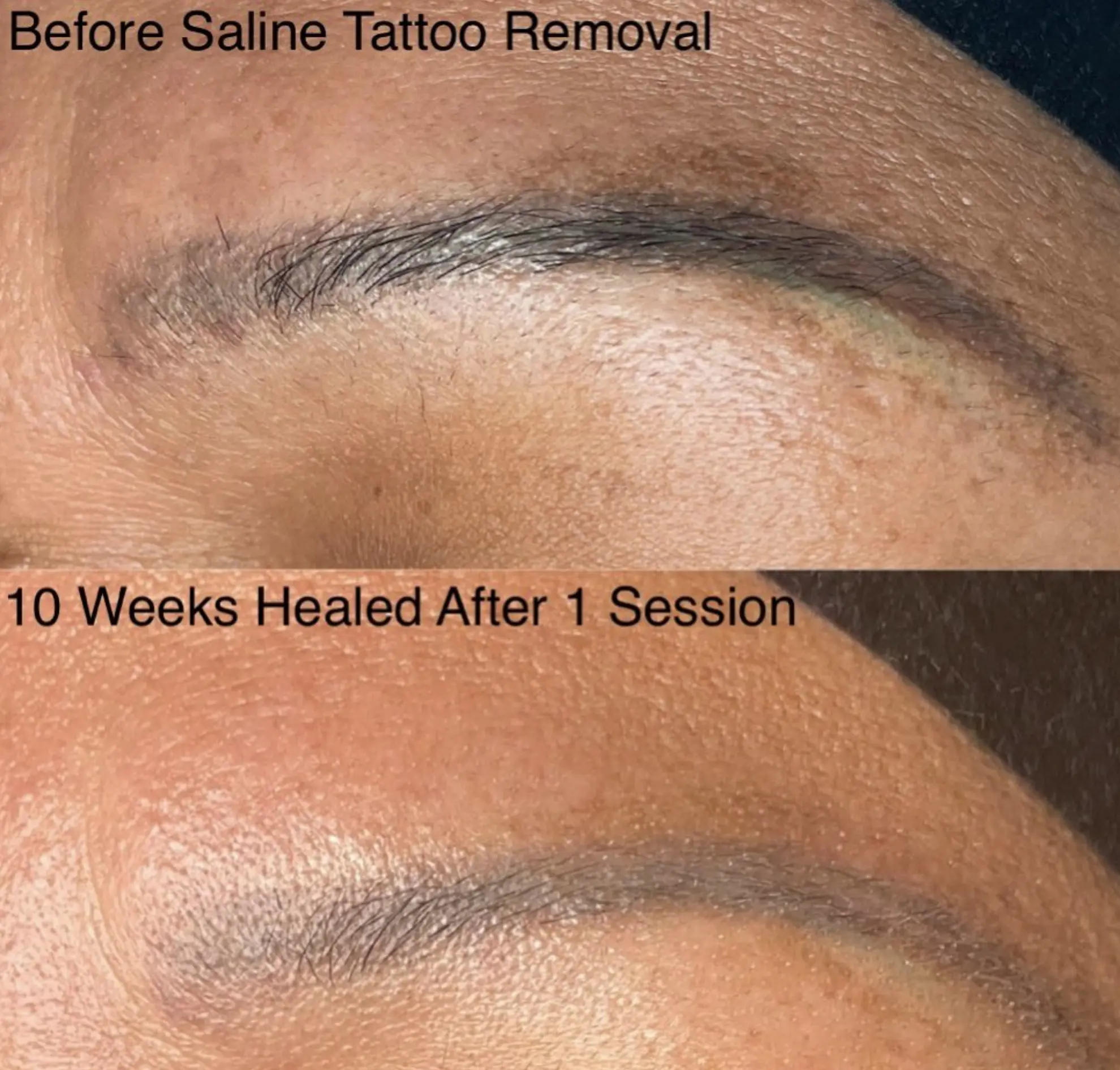 saline solution tattoo removal