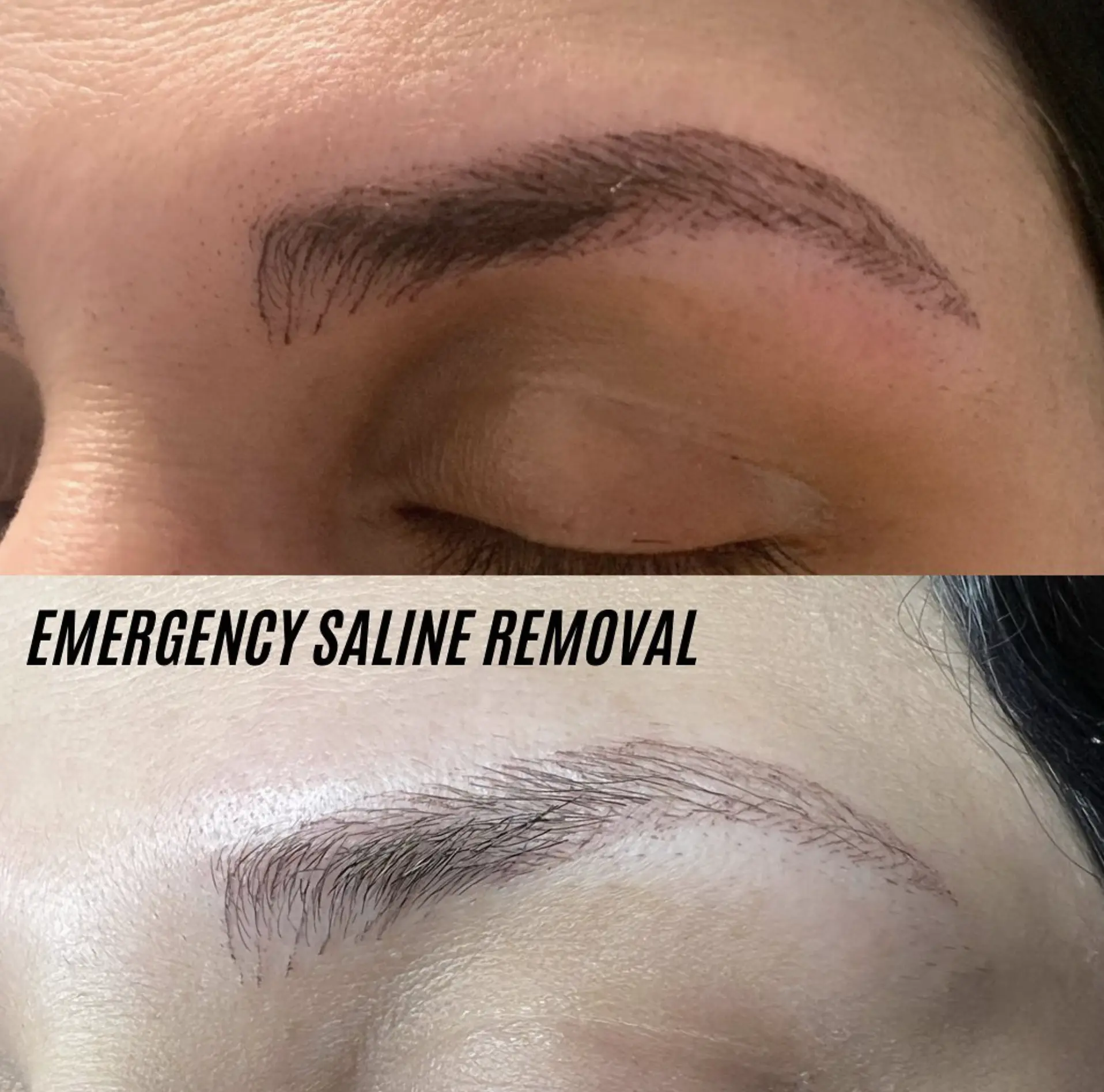 saline tattoo removal near me