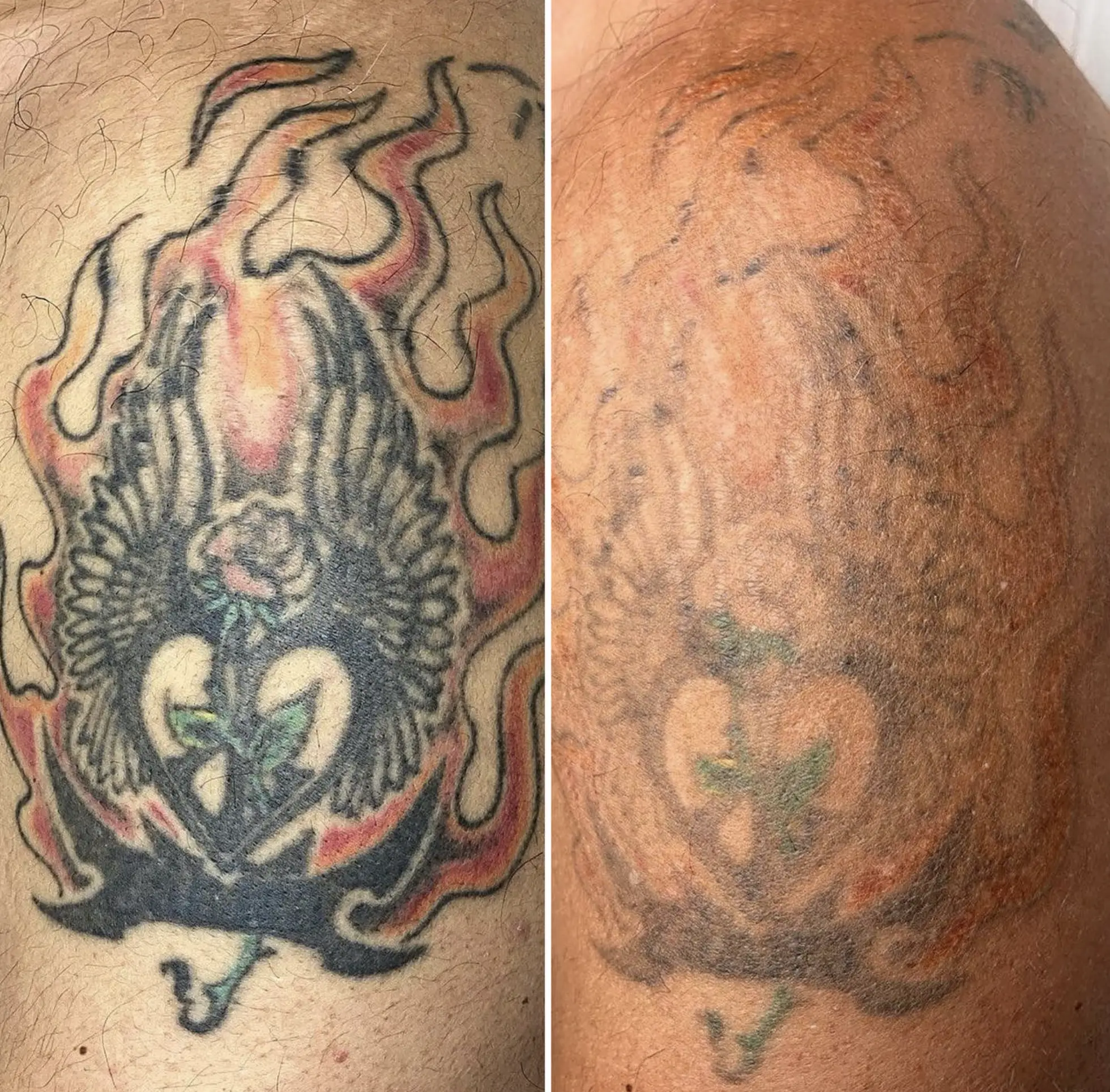 Professional laser tattoo removal session in Melbourne