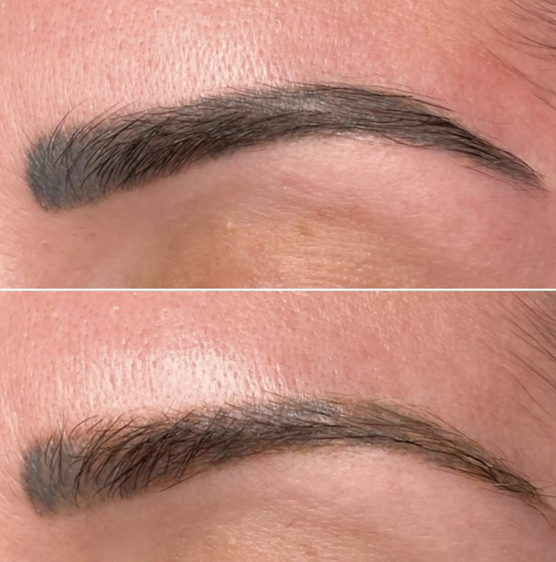 laser tattoo removal session in Melbourne