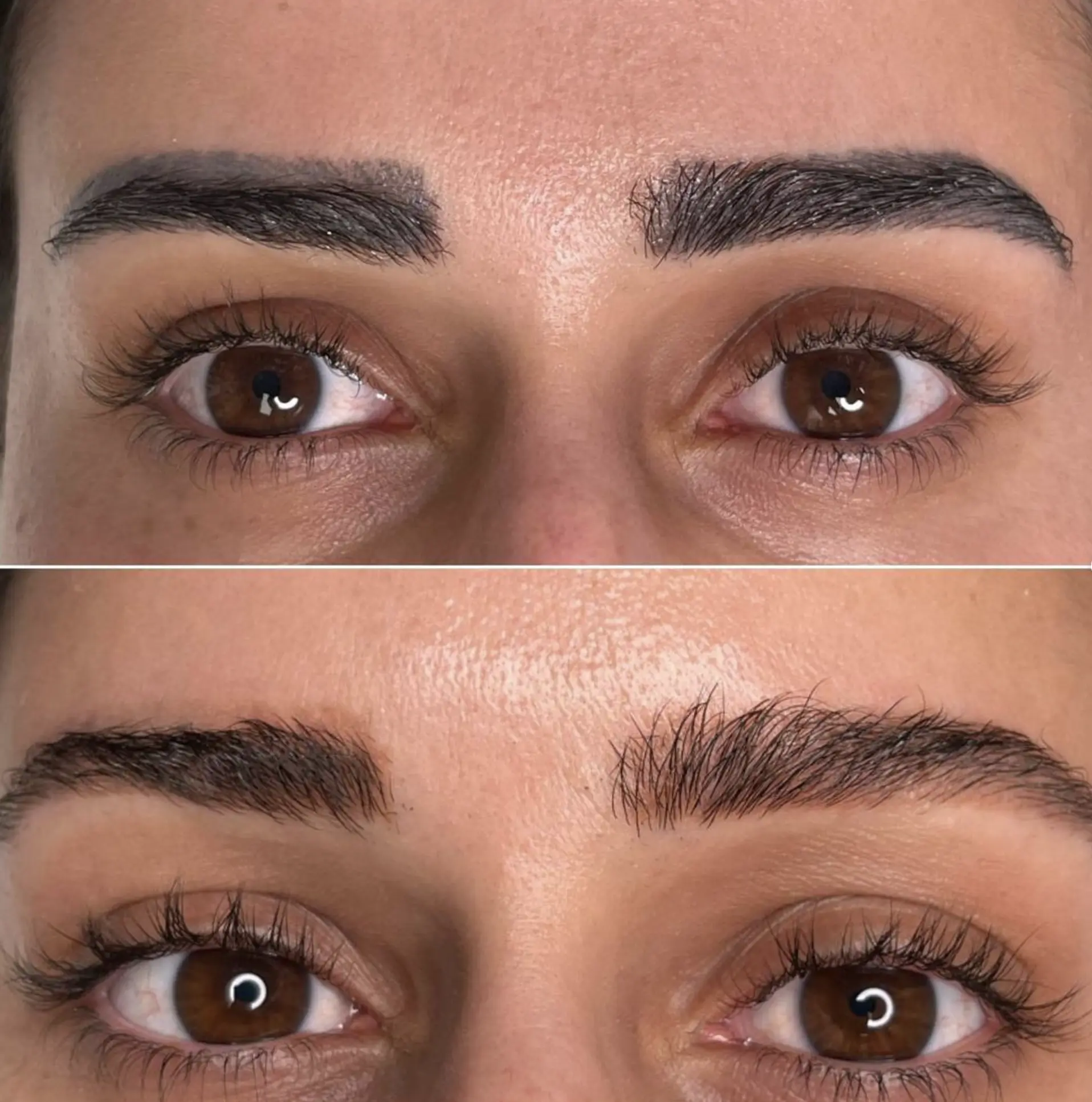 laser vs saline tattoo removal